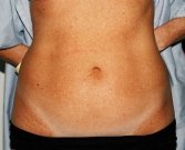Mini tummy tuck San Diego, Case 1 - before