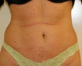 Mini tummy tuck San Diego, Case 1 - after