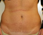 Mini tummy tuck scar, case 1 - after