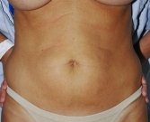Mini tummy tuck San Diego, Case 2 - before
