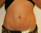 Mini tummy tuck San Diego, Case 2 - after