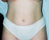 Mini tummy tuck San Diego, Case 3 - before