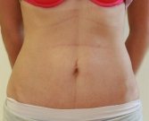 Mini Tummy Tuck San Diego, Case 4 - after