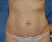 Mini Tummy Tuck San Diego, Case 5 - before