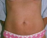 Mini Tummy Tuck San Diego, Case 6 - before