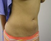 Mini Tummy Tuck San Diego, Case 7 - before