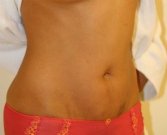 Mini Tummy Tuck San Diego, Case 7 - after