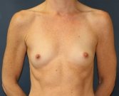 Breast Augmentation Case 58 - before