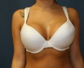 Breast Augment San Diego, Case 59a - after