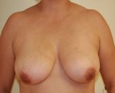 Breast Lift Case 8 - before