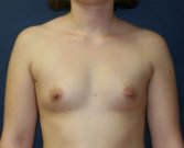 Breast Implants San Diego 62a - before