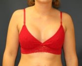 Breast Implants San Diego 62a - after