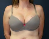 Breast Implants San Diego, Case 49a - after