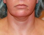 Liposuction Neck San Diego Case 11 - before