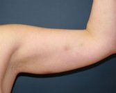 Liposuction left arm - before