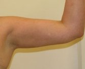 Liposuction left arm - after