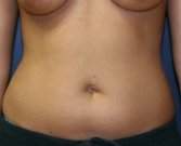 Liposuction abdomen - before