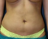 Liposuction abdomen - after