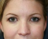 Eyelid Surgery San Diego Case 49 - after
