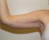 Arms 1 - after