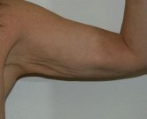 Arm reduction San Diego Case 3 - before