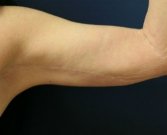 Arm reduction San Diego Case 3 - after
