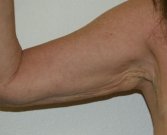 Arm reduction San Diego Case 4 - before