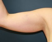 Arm reduction San Diego Case 5 - before