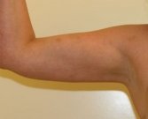 Arm reduction San Diego Case 5 - after