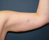Arm reduction San Diego Case 6 - before