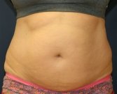 Tummy Tuck San Diego Case 38 - before