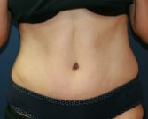 Tummy Tuck San Diego Case 38 - after