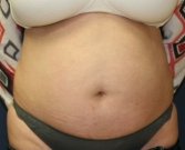 Tummy Tuck San Diego Case 41 - before