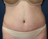Tummy Tuck San Diego Case 41 - after
