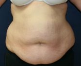 Tummy Tuck San Diego Case 42 - before