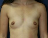 Breast Implants San Diego, Case 65 - before