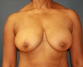 Breast Lift San Diego Case 18 - before