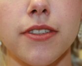 Lips San Diego Case 15 - before