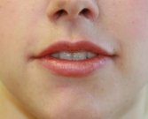 Lips San Diego Case 15 - after