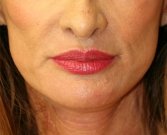 Lips San Diego Case 16 - after