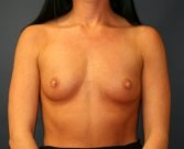 Breast Augmentation San Diego Case 67 - before