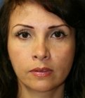 Rhinoplasty 34 (Tip Only) - before