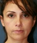 Rhinoplasty 34 (Tip Only) - after