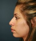 Rhinoplasty San Diego Case 35 - before