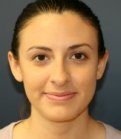 Rhinoplasty San Diego 27 - before
