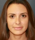 Rhinoplasty San Diego 27 - after