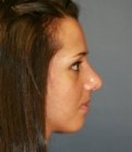 Rhinoplasty case 21 - after