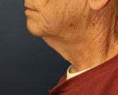 Necklift San Diego Case 20 - before