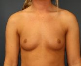 Breast Augmentation San Diego Case 68 - before
