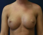 Breast Augmentation San Diego Case 68 - after